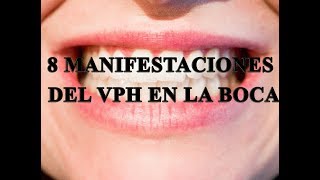 8 manifestaciones de VPH en la boca [upl. by Calabrese]