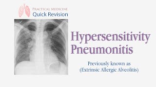 Hypersensitivity Pneumonitis Extrinsic Allergic Alveolitis  EAA [upl. by Sudnac830]