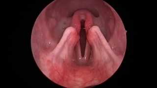 Dog Lar Par Laryngeal paralysis observed in sedated canine oral exam [upl. by Akeret752]