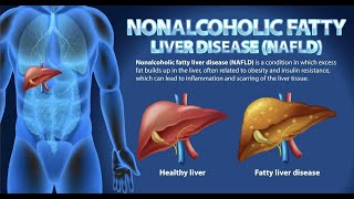 The Silent Epidemic Fatty Liver [upl. by Cob508]