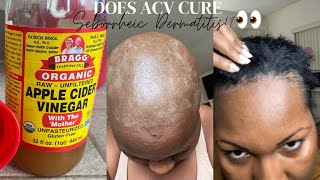 Treating My Seborrheic Dermatitis with ACV RINSE Remedy 🙆🏾😫👀😅 [upl. by Ruhtra]