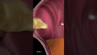 What Is Acid Reflux Animation [upl. by Schellens877]