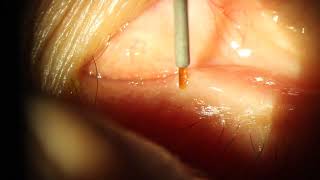 Oasis Form Fit Hydrogel Canalicular Punctal Plug Insertion [upl. by Lurie]