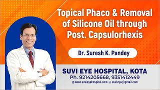 Topical Phaco amp Removal of Silicone Oil through Post Capsulorhexis Dr Suresh Pandey [upl. by Rochelle]