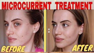 MICROCURRENT FACIAL BEFORE AND AFTER  NUOVALUCE MICROCURRENT REVIEW 2021  Madella Beauty [upl. by Amora]