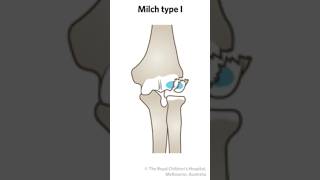 Lateral condyle fracture neetpreparation orthopedics [upl. by Procora]