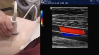 How To Lower Extremity Arterial Duplex Exam [upl. by Desimone]