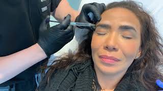 Brow Lift Using Fillers  Restalyne Defyne for Brows  West Hollywood CA  Dr Jason Emer [upl. by Nunci]