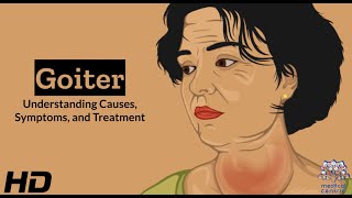 Thyroid Troubles Navigating Goiter  Causes Symptoms and Treatment Explained [upl. by Hotchkiss173]