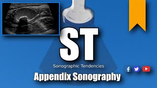 Appendix Ultrasound [upl. by Atsylak]