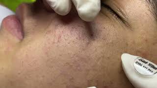 Acne treatment for Spa Linh Mun 2023 026 [upl. by Vatsug]