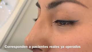 Postoperatorio de rinoplastia ultrasónica a los 7 días [upl. by Filler]