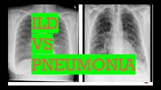 Chest Xray interstitial lung disease vs PneumoniaTypes of opacities in lungs [upl. by Alahsal]