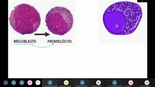 Leucemia Mielóide Crônica e Aguda [upl. by Adnalro]