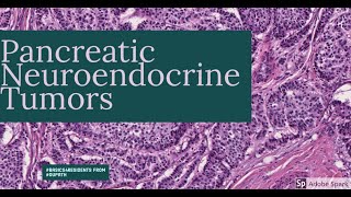 Pancreatic neuroendocrine tumors [upl. by Nerw]