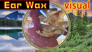 Ear wax removal amp Ear Cleaning （15） [upl. by Barr328]