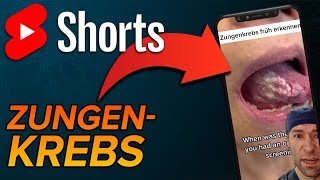 Zungenkrebs shorts [upl. by Zenas718]