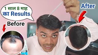 Hair Transplant Bhopal City amp Raipur Chhattisgarh  Mintop 5 Results Minoxidil Hair Regrowth Results [upl. by Astiram557]