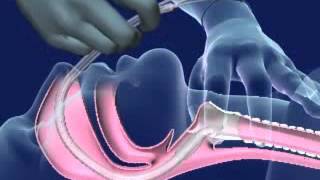 Nasal Intubation [upl. by Pagas534]