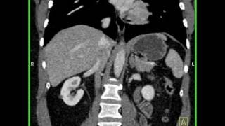 Abdomen Liver Hemangioma of the Liver6 of 8 [upl. by Lewert]