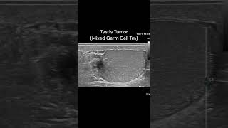 Testicular Mass ultrasound testis cancerawareness radiology cases [upl. by Kristof]