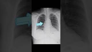 Fusiform aneurysmal dilatation of ascending aorta [upl. by Thgirw]