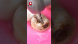 Decayed Tooth Reconstruction faketooth toothfilling toothdecay shorts [upl. by Savell267]