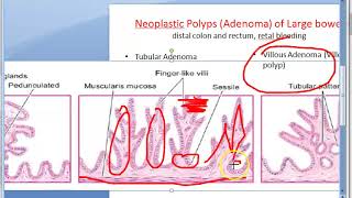 Pathology 521 g Neoplastic polyp tubular adenomatous villous papilloma tubulovillous papillary [upl. by Bivins]