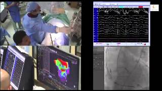 VT ablation with 3D electro anatomical mapping in a patient with VT storm and multiple CRTD shocks [upl. by Sew183]