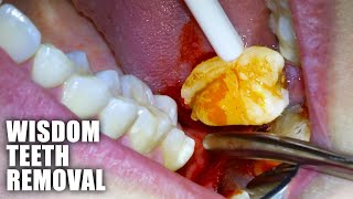 Full Wisdom Teeth Removal Procedure Emergency Extraction of Impacted amp Partially Erupted Molar [upl. by Rives]