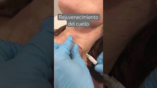 Rejuvenecimiento del cuello con Radiesse [upl. by Fabrianna]