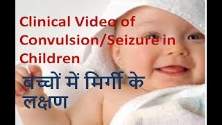 clinical video of convulsionseizure in children [upl. by Relyt]