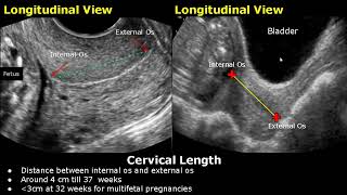 How To Measure Cervical Length On Ultrasound  Transabdominal And Transvaginal Views  Cervix USG [upl. by Anak]