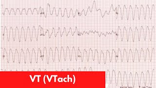 VT vs SVT with Aberrancy  For DO MD NP PA Part 6 [upl. by Dalila]