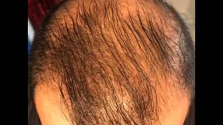 14 month’s using minoxidil  Rogaine 5 Before amp After results [upl. by Atilal1]