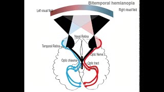 Lesion at the Optic chiasma and Bitemporal Heteronymous Hemianopia [upl. by Minna409]