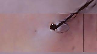 Removal of ingrown hair [upl. by Drawd]