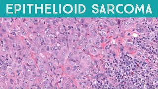 Epithelioid sarcoma explained in 5 minutes pathology dermpath dermatopathology dermatology [upl. by Ydnal]