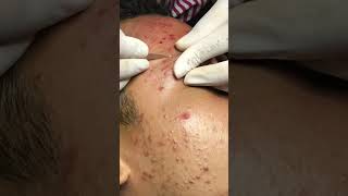 Best Pimple Popping 16 beautiful blackheads sacdepspa [upl. by Shotton942]