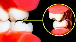 Comment Arrêter de Grincer Des Dents la Nuit [upl. by Nitsrek]