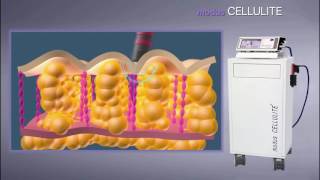 MODUS CELLULITE  AWT Acoustic Wave Therapy [upl. by Carla]