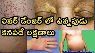 Liver Disease and Symptoms Detailed Video in Telugu [upl. by Margareta970]