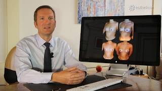 Augmentation des seins  silhouette affinée  Lipofilling Mammaire [upl. by Espy]