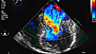 Mitral Valve Prolapse and Mitral Regurgitation  Echocardiography [upl. by Snoddy]