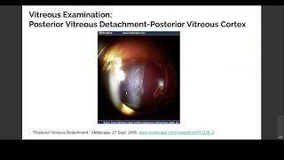 Part 2 Examination of Vitreous and Floaters [upl. by Pigeon]