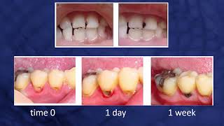 FIGHTING CAVITIES WITHOUT A DENTIST DRILL [upl. by Ssor]