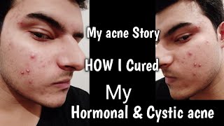 My acne story amp Skincare journey  Saslic face wash  deriva bpo gel  clearwin gel  glocin gel [upl. by Ojybbob]