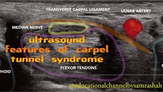 Ultrasound Features of Carpel Tunnel Syndrome [upl. by Ainessej]