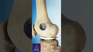 Cartilage Tumor Surgery 3D Animation [upl. by Ewald]