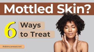 6 simple ways how you can treat your mottled skin Causes and prevention skincare dermatology [upl. by Yasmin553]